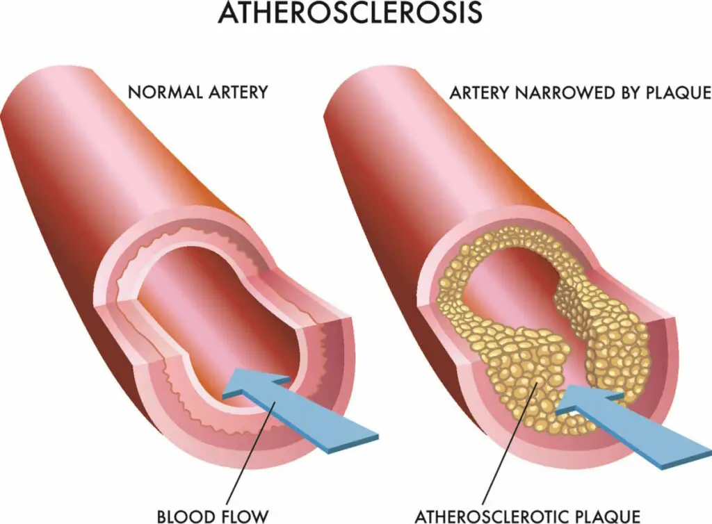 atherosclerosis